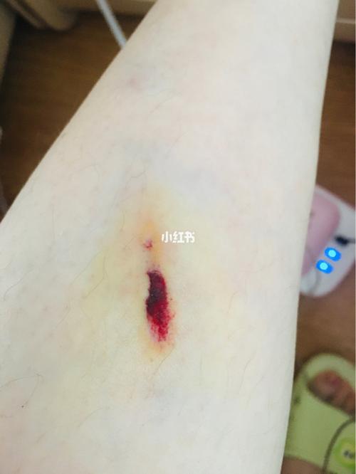 只是皮肉伤，别大意！伤口护理要注意
