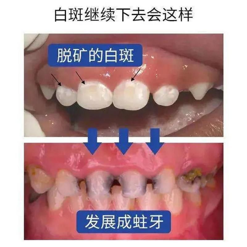如果牙齿上出现小白点我们应该怎么处理？