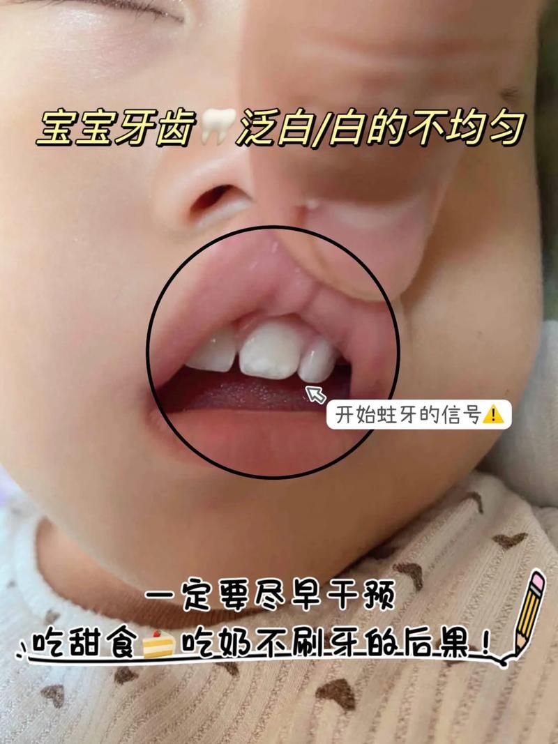 牙齿上出现小白点，需要看牙医吗？