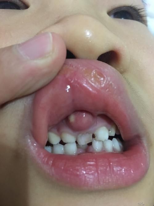 牙龈肿胀是什么病？看图识病，肉牙肿症状及处理方法！