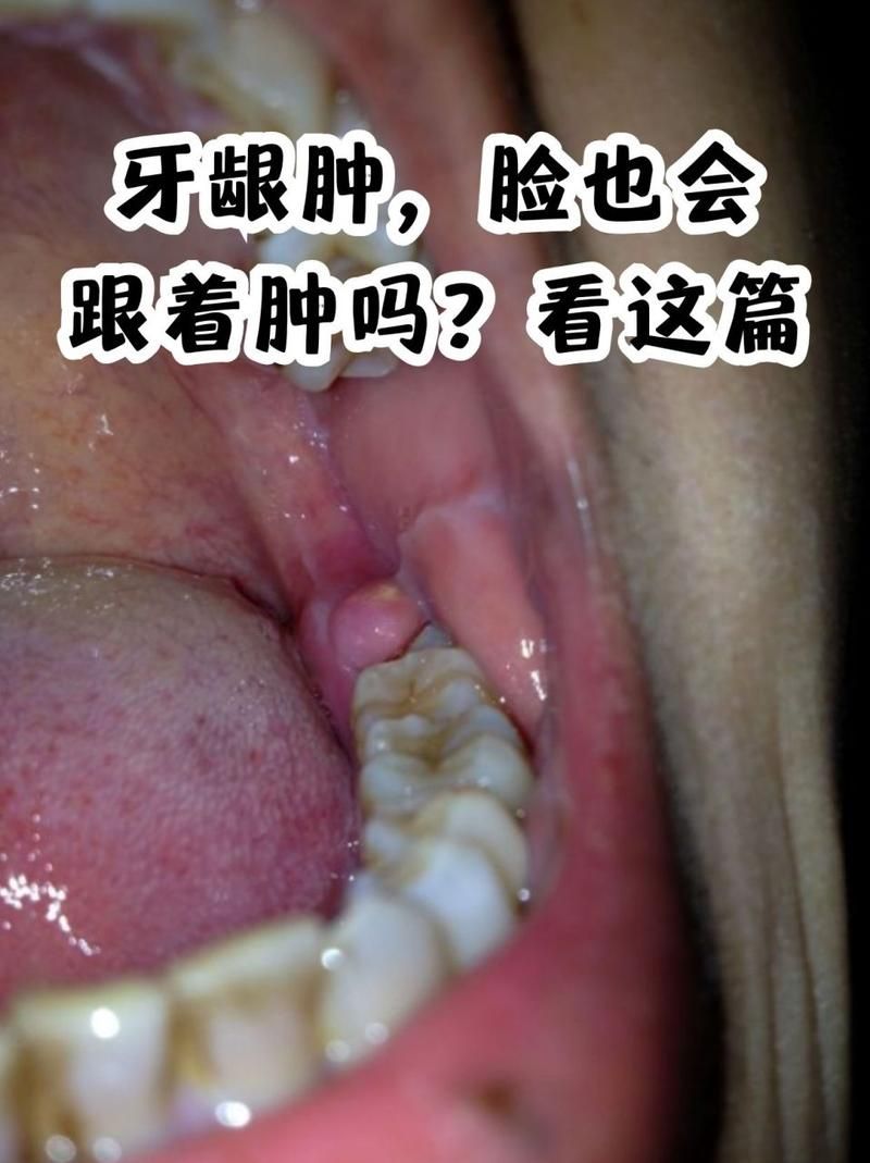 牙龈肿胀是什么病？看图识病，肉牙肿症状及处理方法！