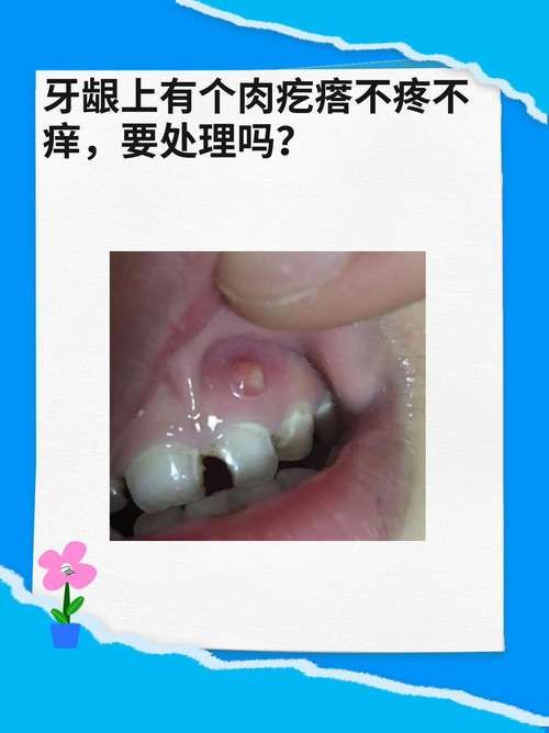 牙龈肿胀是什么病？看图识病，肉牙肿症状及处理方法！