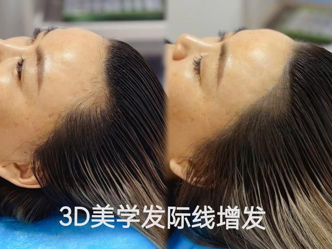 美图秀秀修发际线技巧：告别尴尬发际线