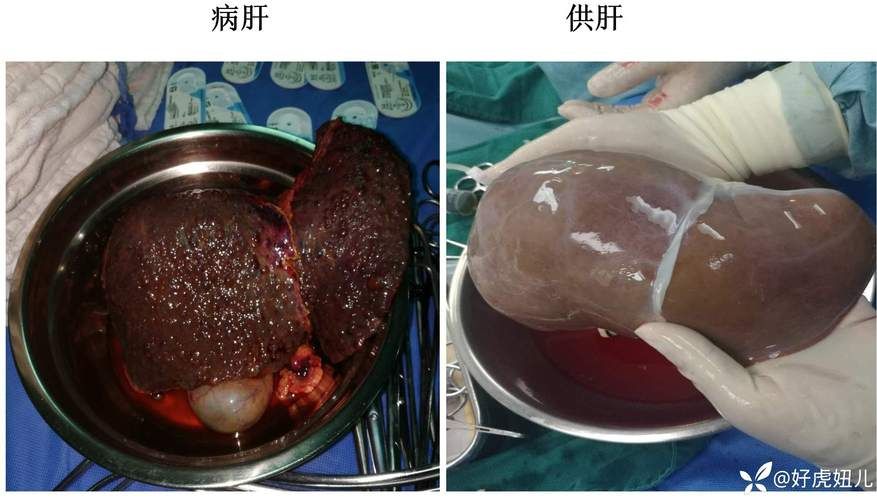 肝移植手术费用要多少？深度解析及省钱技巧分享